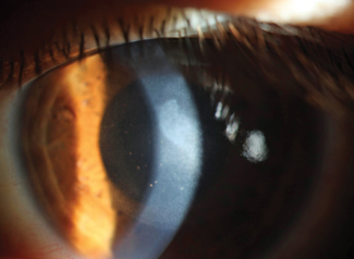This resolving corneal edema has keratic precipitates directly behind it. 