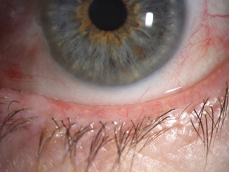 Fig. 2. Signs of blepharitis and low lacrimal lake noted prior to cataract surgery.