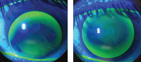 An inferiorly decentered multifocal GP with excessive movement, at left, will cause blurred, fluctuating vision and discomfort. To improve fit and vision, steepen the base curve and increase the overall diameter, at right. Photos: Thuy-Lan Nguyen, OD