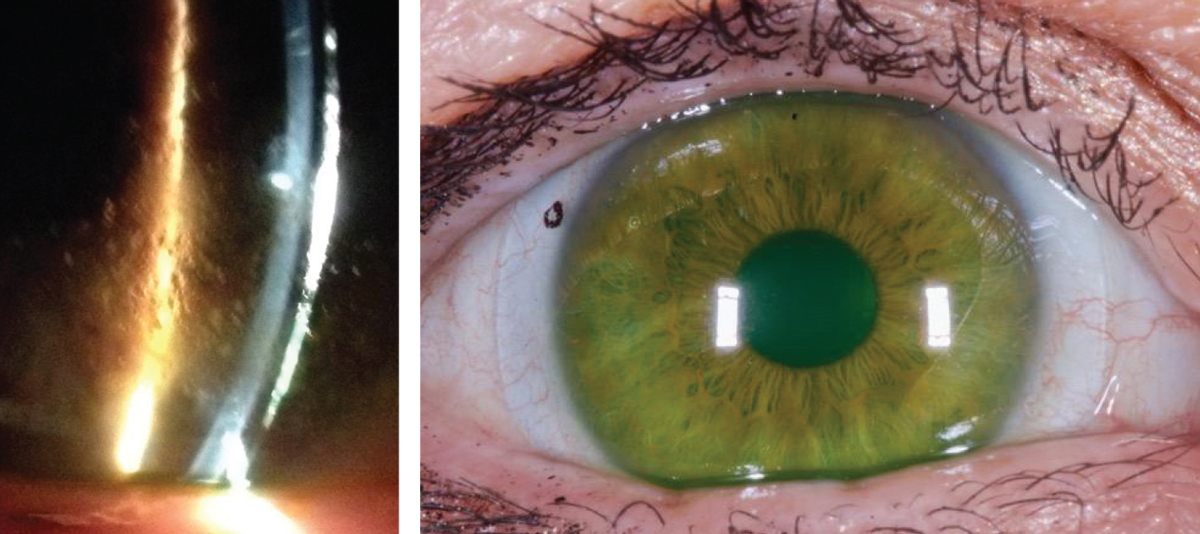 Figs. 2a and 2b. At left, significant surface debris on the lens surface before Hydra-PEG treatment. At right, improved surface wettability after Hydra-PEG treatment. Images: Tom Arnold, OD