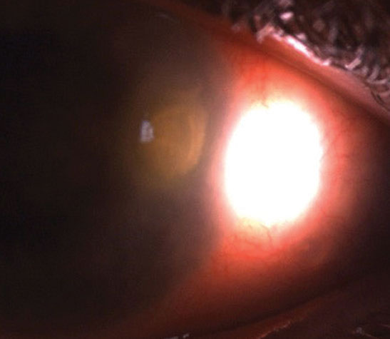 This large epithelial defect overlies a dense stromal infiltrate in microbial keratitis. The patient presented with significant pain, mucopurulent discharge and reduced vision.