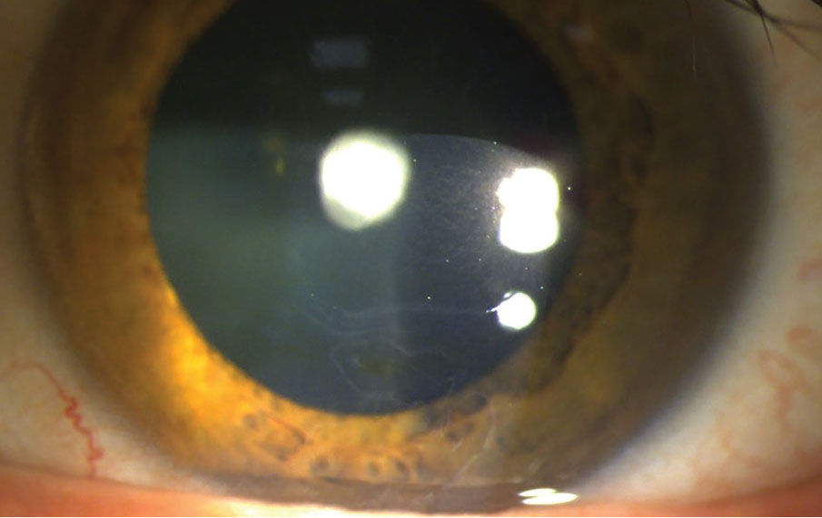 Fig. 1. Slit lamp photo of a patient with EBMD OS and a history of multiple RCEs. Patient is scheduled to undergo PTK surgery OS. A polar cataract is also captured in this photo.