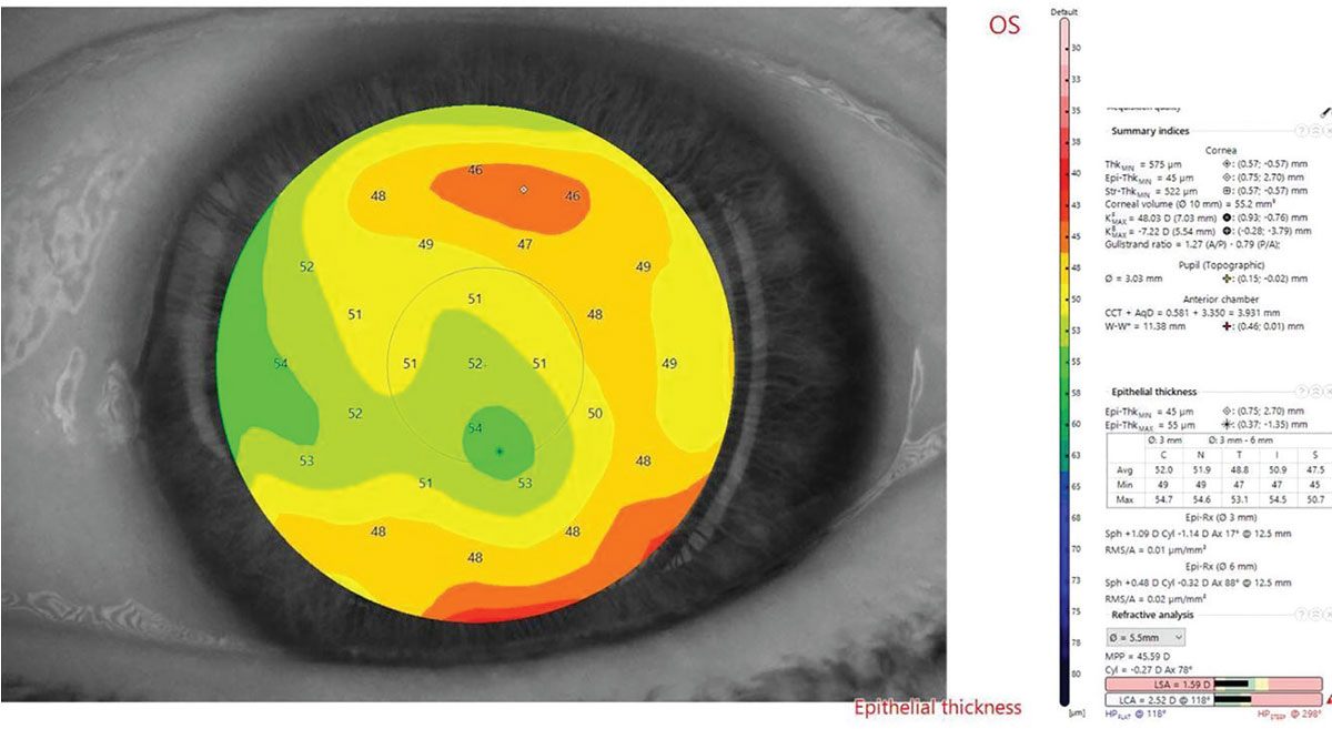 Fig. 5. Epithelial thickness mapping in Case A shows thickening overlying the depressed corneal scar.