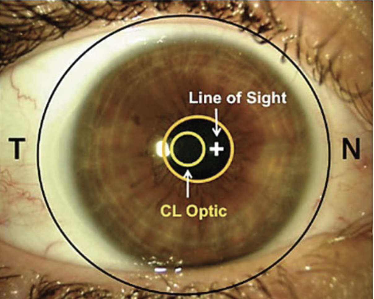 Fig. 5. The optical center of most lenses aligns with the pupil center and cornea, which are inferior and temporal of the line of sight. The Zenlens allows alignment of the visual axis and the center of the near zone for better acuity. 