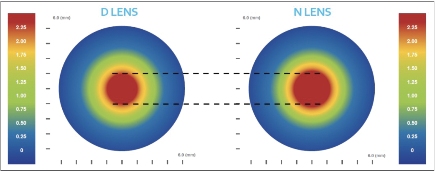 Fig. 6. The Onefit scleral lens MF features an adjustable near-zone diameter for the dominant (“D” lens) and non-dominant (“N” lens) eye.