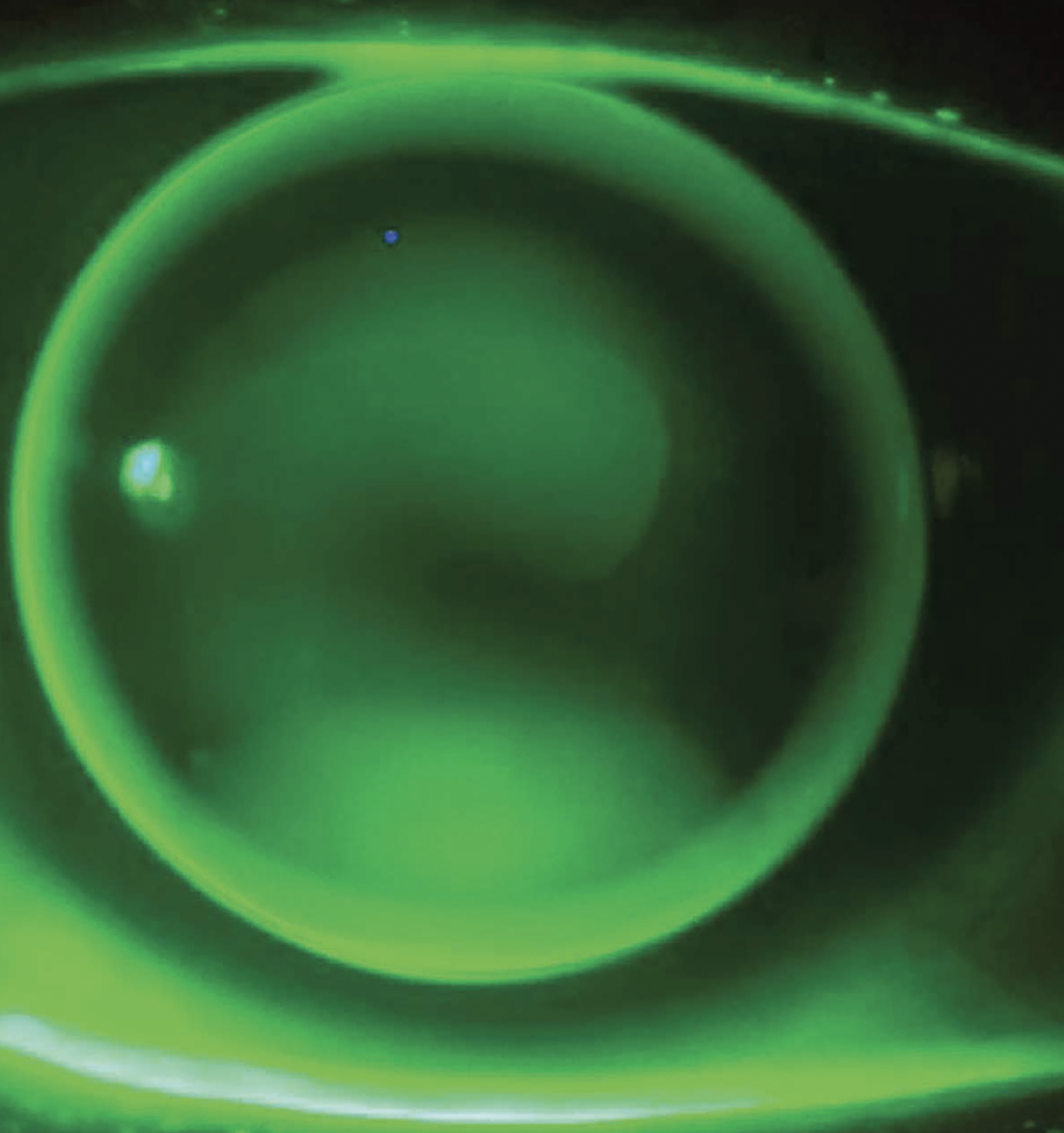 Fig. 7. Corneal GP MFs are available in translating, concentric and aspheric lens designs. They can be fitted for patients with keratoconus, corneal astigmatism, presbyopia and other vision concerns.