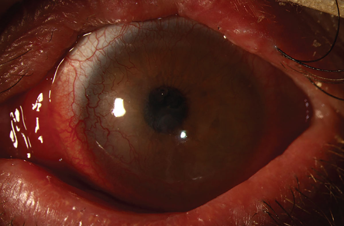 Fig. 1. Slit lamp photo of the patient’s left eye with a scleral lens in place.
