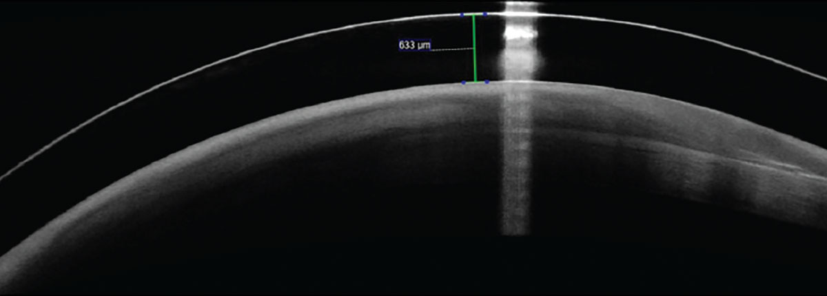 Fig. 4. OCT of a scleral lens over the patient’s left eye. The corneal surface has become completely conjunctivalized. 