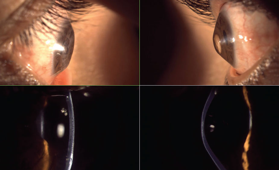 Fig. 2. Severe oblate (left) and prolate (right) corneas with lateral gross observation and optic section biomicroscopy—interestingly, from the same patient.