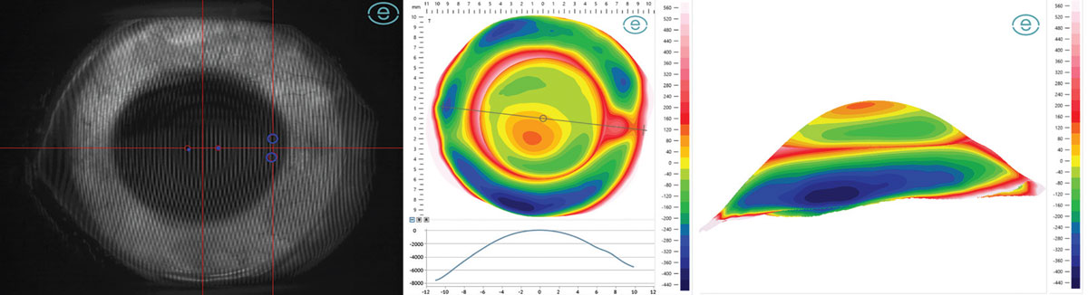 Fig. 7. Fourier projection grid (left), 20mm profilometry elevation map with meridian profile (center) and three-dimensional reconstruction (right) of eye with keratoconus and pinguecula. 