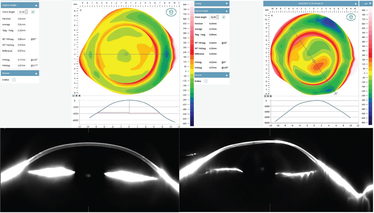 Fig. 12a. Patients A and B demonstrate similar corneal curvatures but with different sagittal heights. Corneo-scleral profilometry map, meridian profile simulation and actual meridian profile as imaged with Fourier projection profilometry and Scheimpflug tomography, respectively.