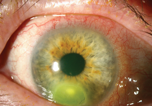 Pseudomonas Aeruginosa Infection In Eye Carpet Vidalondon