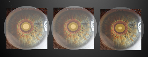 Various multifocal zone sizes within a pupil. Image: Robert L. Davis, OD