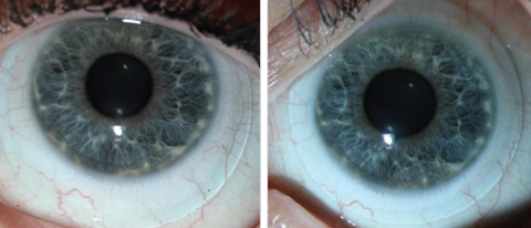 Fig. 4. These images show an inferiorly decentered scleral lens, at left, vs. a well-centered scleral lens, at right. This improvement in centration was accomplished by decreasing the diameter of the lens.