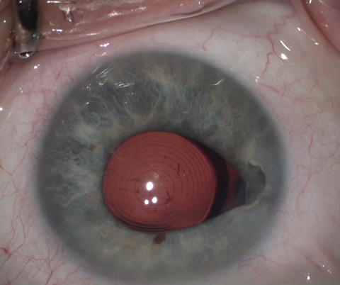 Fig. 2. The Symfony IOL uses refractive echelettes that appear similar to the concentric rings of a multifocal but diffract rather than split the light entering the eye. Photo: Derek Cunningham, OD, and Walter Whitley, OD