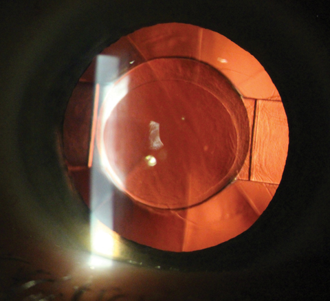 Fig. 1. The Crystalens AO accommodating IOL avoids the glare and halos of multifocals. Photo: Justin Schweitzer, OD