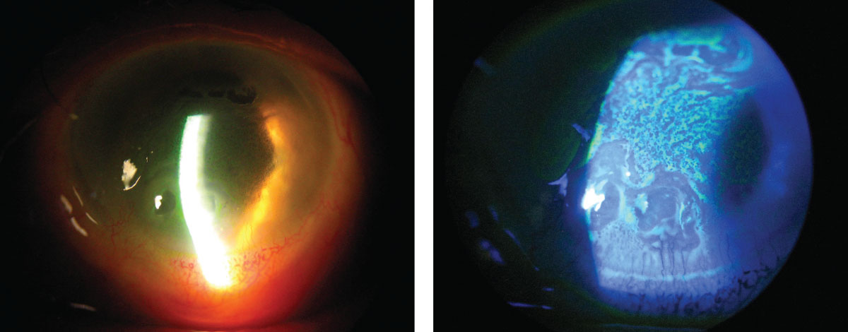 At left, this patient has severe corneal edema associated with complicated cataract surgery. At right, the same patient’s corneal epithelium and irregularity can be easily seen with the sodium fluorescein dye pattern.