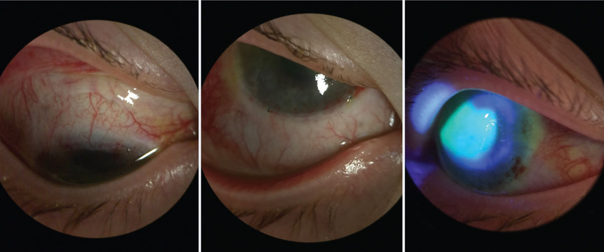 Same patient from Figure 4, one week postoperative after Ir-CLAL. You can see the recessed conjunctiva superior and inferior along the limbus. The patient’s central cornea has stain pooling as it continues to re-epithelialize, but there is no peripheral late staining.