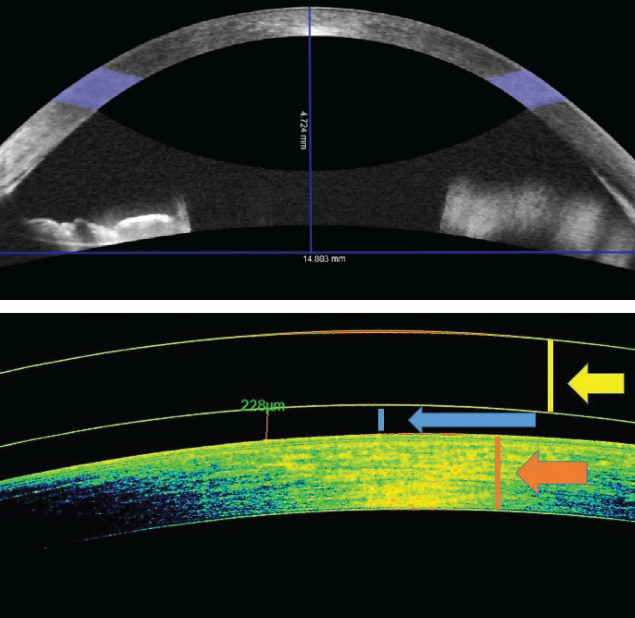 OCT of the anterior chamber can measure sagittal height as well as lens clearance—a beneficial tool for fittings.