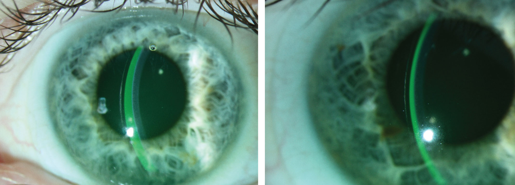At right, the tear film and lens thickness are almost equal. The lens on the left shows excessive clearance, which could lead to decreased vision, post-lens debris and conjunctival impingement.