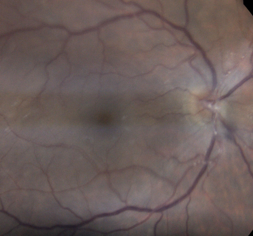 Posterior segment involvement shows occlusive arteritis of the primary retinal arterioles. These Kyrieleis plaques are associated with ARN. 