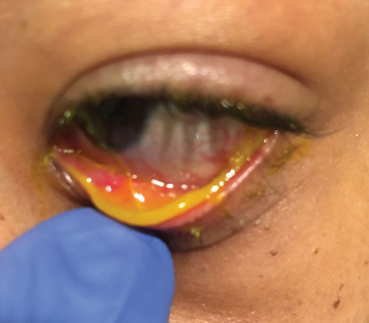 Risk factors, clinical features and outcomes of Neisseria keratitis
