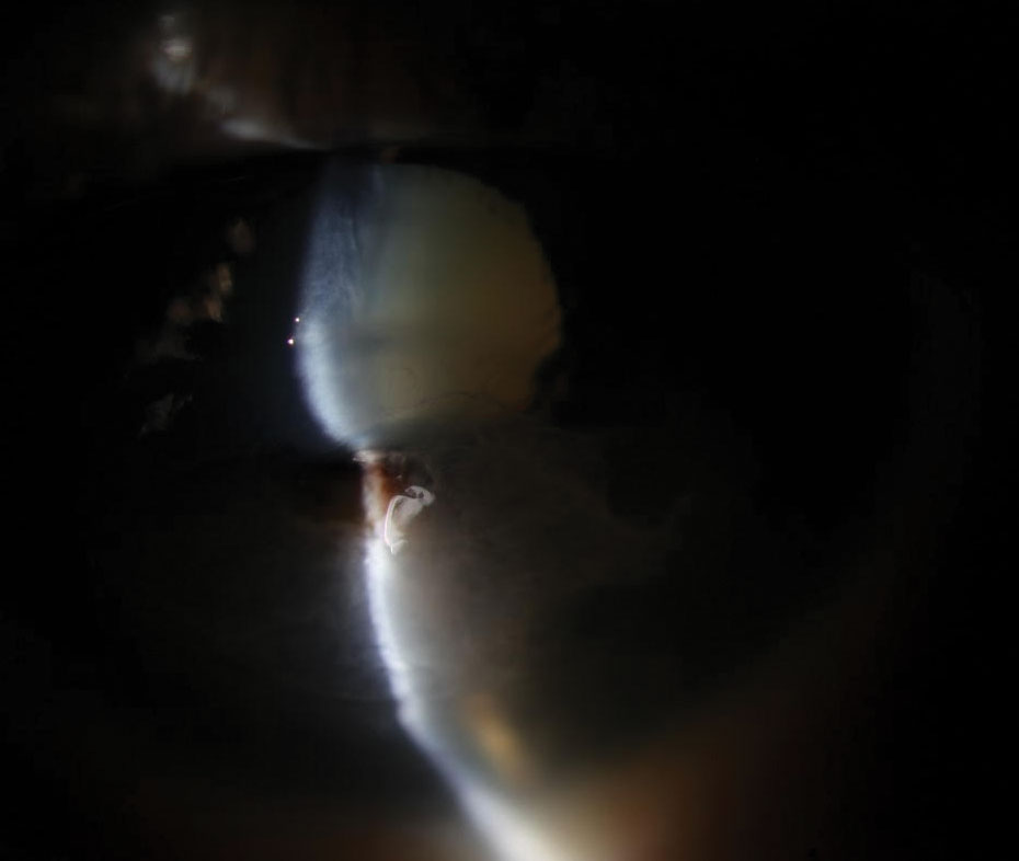 Take On Neurotrophic Keratitis With These Clinical Tools