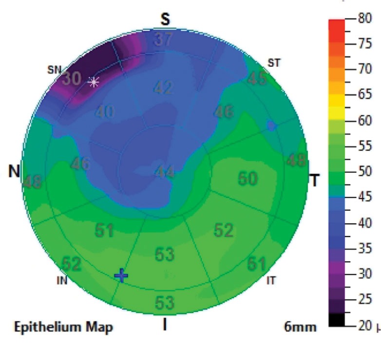 Fig. 1. Epithelial thickness map shows thinning where the map pattern is located.