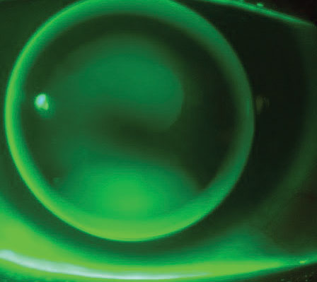 Corneal lens displaying feather apical touch with divided support in a mild keratoconic eye.