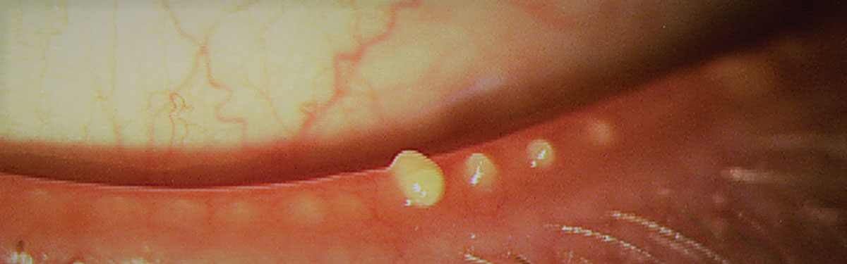 Fig. 4. Blocked meibomian glands after manual expression. The cloudy appearance suggests poor meibum quality. 