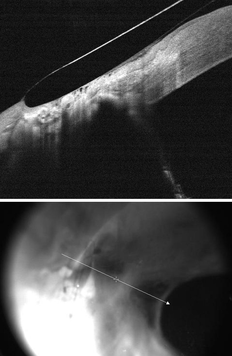 The patient in Figure 1 was refit with a scleral lens with a lower edge to better align with the conjunctival depression. The patient reported better vision throughout the day.