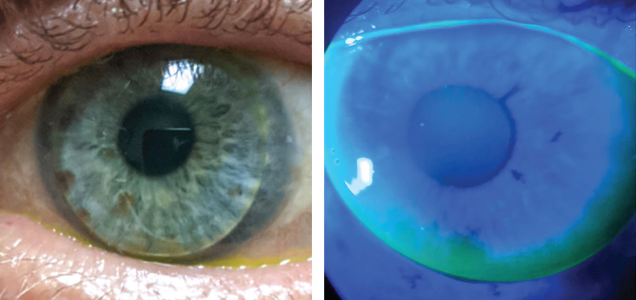 The patient in case 3 had keratoconus in his left eye and slight, but acceptable, inferior edge lift remains after ACT adjustment in the right eye.