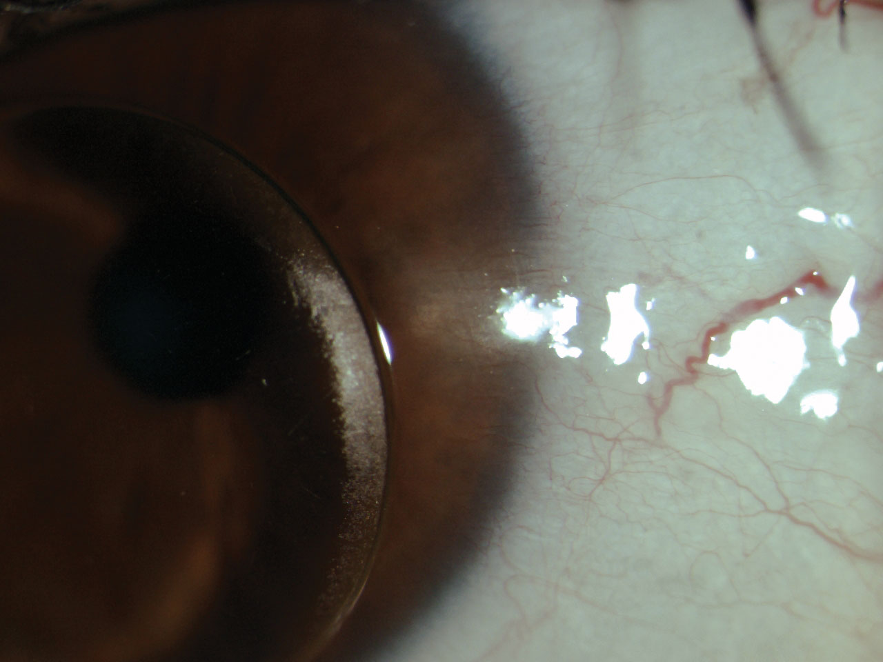 Scarring and neovascularization in the limbal region from VLK is visible.