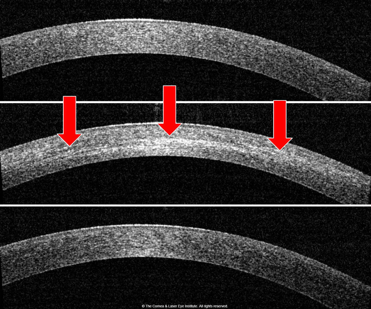 Fig. 1b. Corneal OCT shows the development of corneal haze from the pre-op (top) to one month post-op (middle). Note the presence of the demarcation line (red arrows), then resolution of corneal haze from the one-month post-op to the 12-month post-op (bottom). 