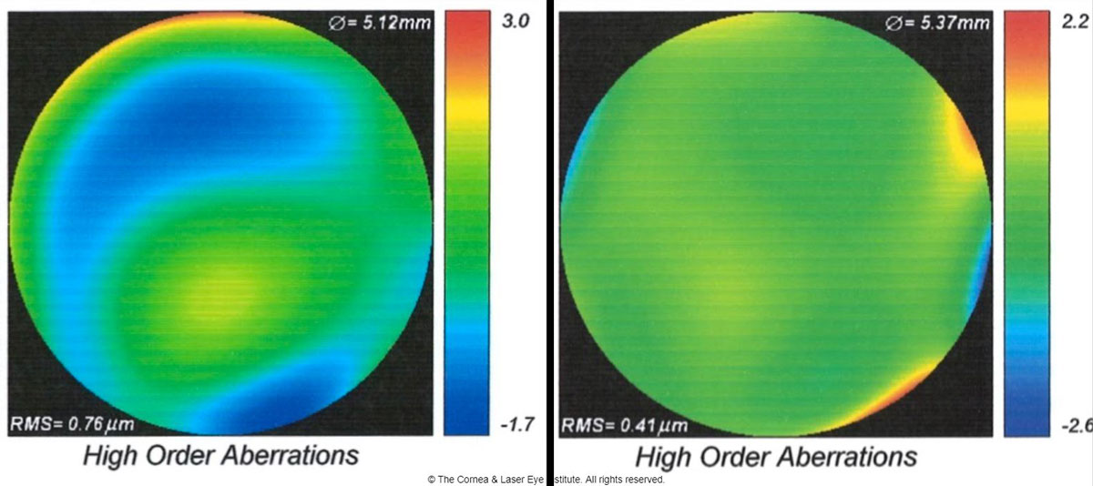 Fig 5. These are the total higher-order aberration maps of an eye of a patient with severe keratoconus while wearing a scleral lens. The map of total aberrations while wearing the final scleral lens corrected with spherical optics and a plano over-refraction (left) is compared with the final customized higher-order aberration correcting optics (right). A 46% reduction of total higher-order root mean square values was observed, translating to one to two lines of visual acuity improvement.