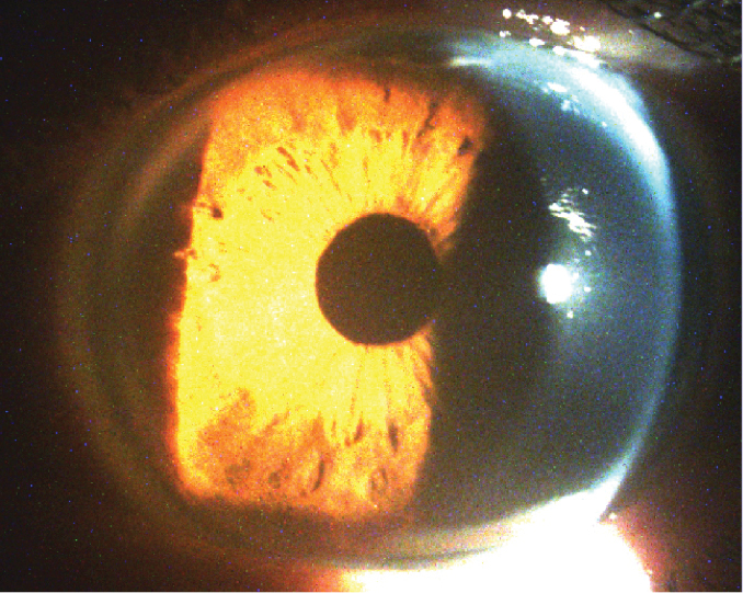 Fig. 2. A large HVID and deep anterior chamber are both characteristic signs of megalocornea.