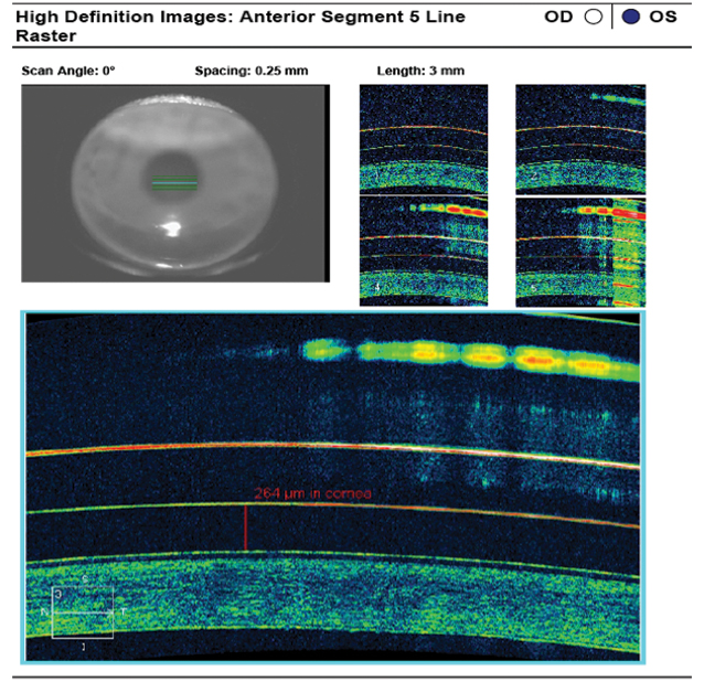 Fig. 4. AS-OCT of the 4300µm/38/44/8.4mm/16.0mm scleral lens reveals ideal apical tear film thickness after one hour of lens settling.