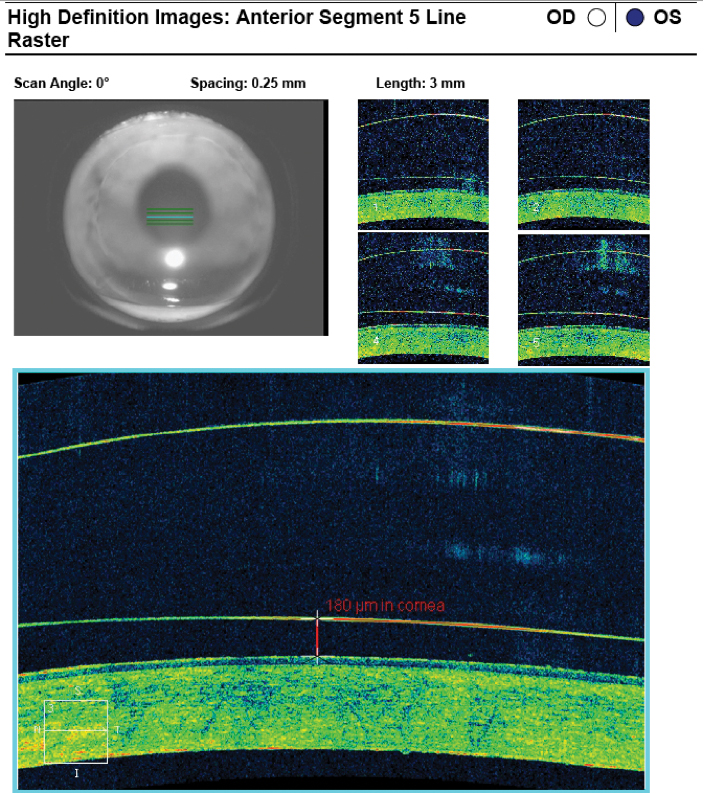 Fig. 10. AS-OCT revealed an ideal tear film thickness of 180µm at the apex after lens settling with the 4400µm/44/50/9.0mm/17.5mm scleral lens.