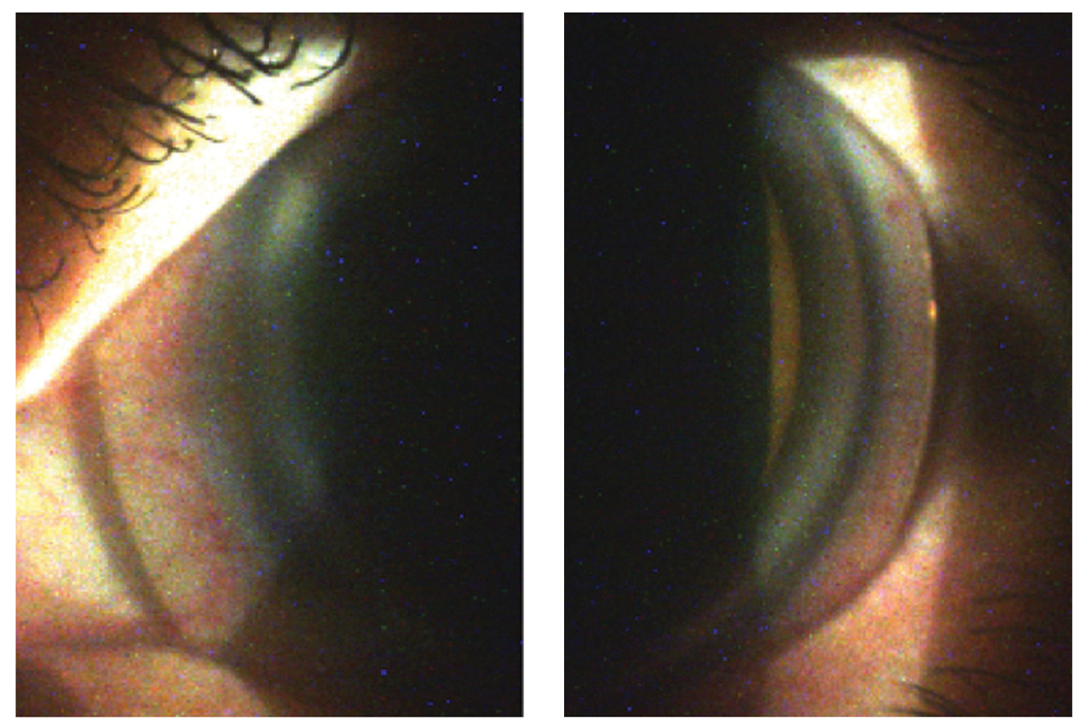 Fig. 11. Despite the nasal (left) and temporal (right) edge lift findings of the 4400µm/44/50/9.0mm/17.5mm scleral lens on slit lamp examination, the patient reported excellent comfort with wear.
