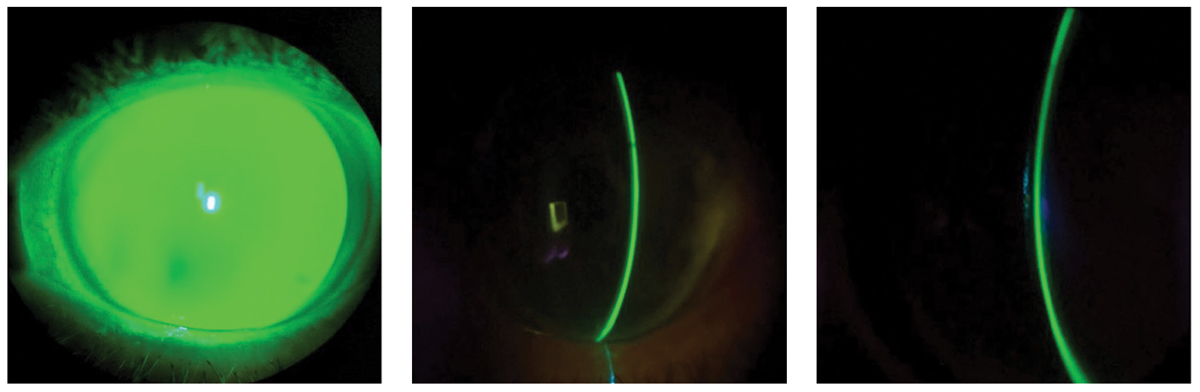 Fig. 9. The diffuse beam (left) and optic sections (center and right) on slit lamp examination of a scleral lens filled with preservative-free 0.9% NaCl solution and fluorescein dye show apical alignment with peripheral clearance from limbus to limbus.