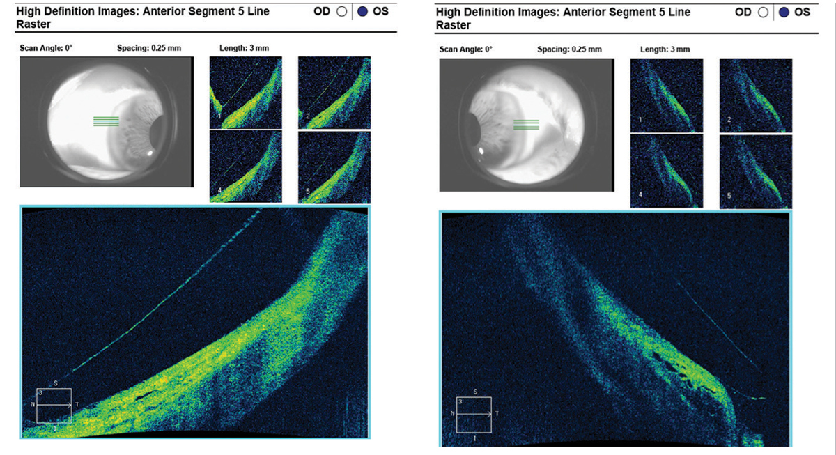 Fig. 12. With modified SynergEyes VS scleral lens parameters, the scleral landing zone showed ideal alignment at the nasal quadrant (left) and mild edge lift on the temporal sclera (right) on AS-OCT.