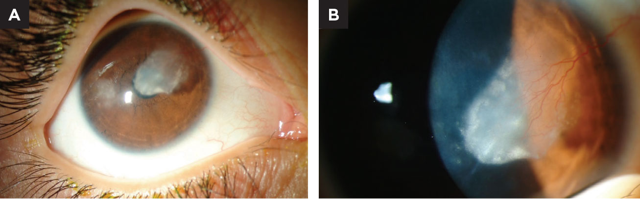 (A) This child has a history of bilateral herpes simplex keratitis (top). Notice the dense lipid deposition in the pupillary axis. (B) Closer magnification reveals a major feeder vessel is the cause of lipid exudation.