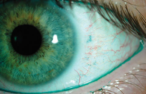 Lens discomfort, commonly caused by dry eye, is a leading cause of dropout.