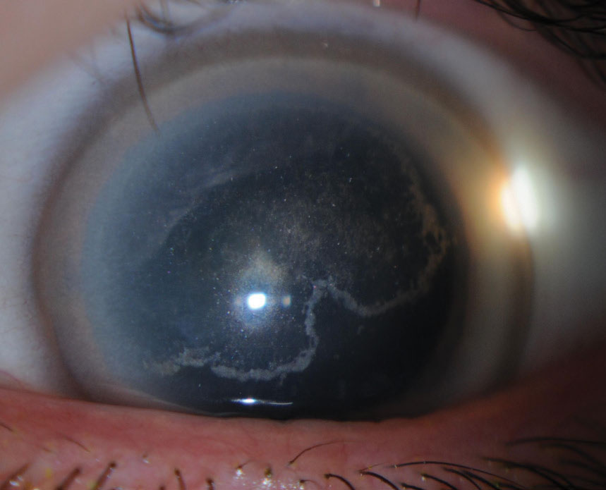 Fig. 3. Signs of Schnyder corneal dystrophy include decreased photopic visual acuity, glare and decreased corneal sensitivity.