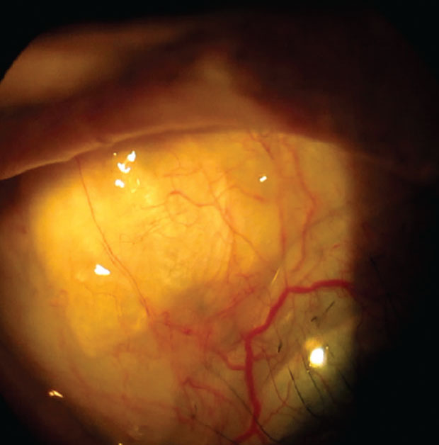 A notch in the scleral lens periphery helps avoid touch with the superior nasal bleb. 