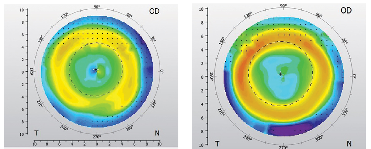 Figs. 5 and 6. Post-ortho-k day-one (left) and two-week (right) follow-up and topography OD.