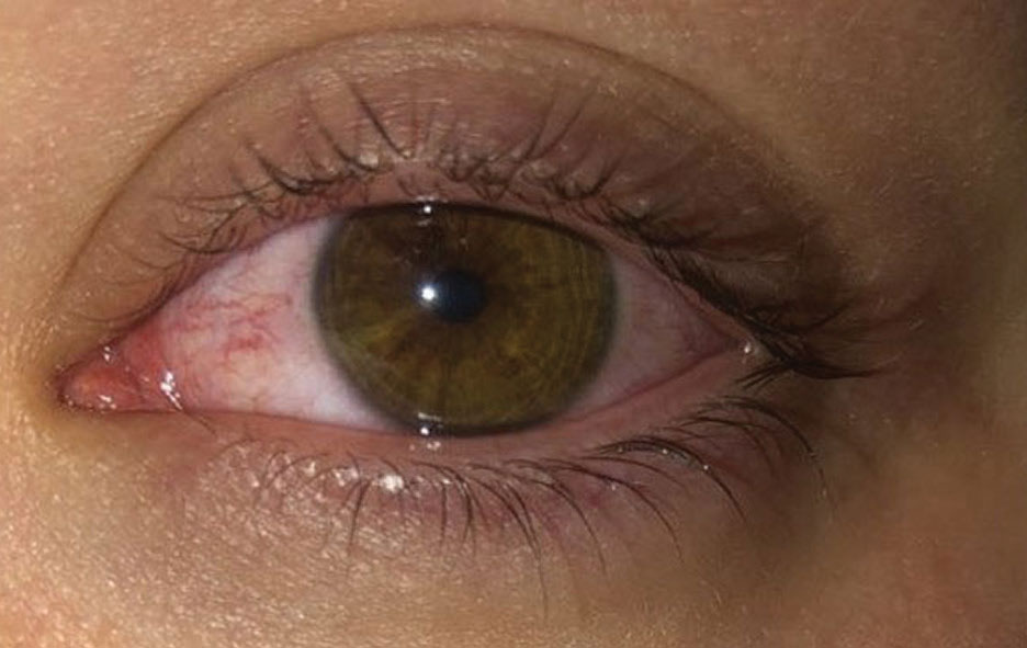 What is the name for the lighter coloured rings/lines within the eye?  Example below. - Quora