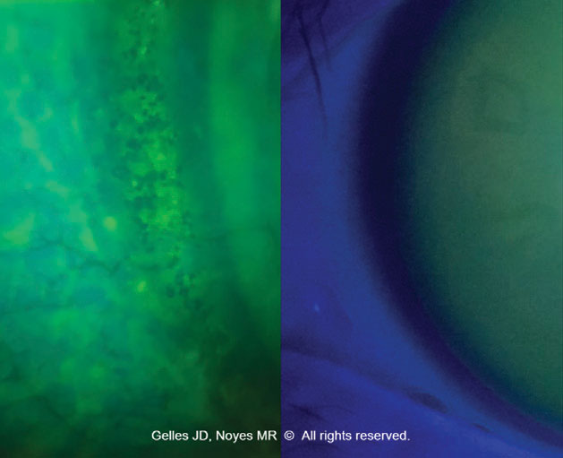 Fig. 1. Epithelial disruption and microcysts due to scleral lens bearing at the limbus.
