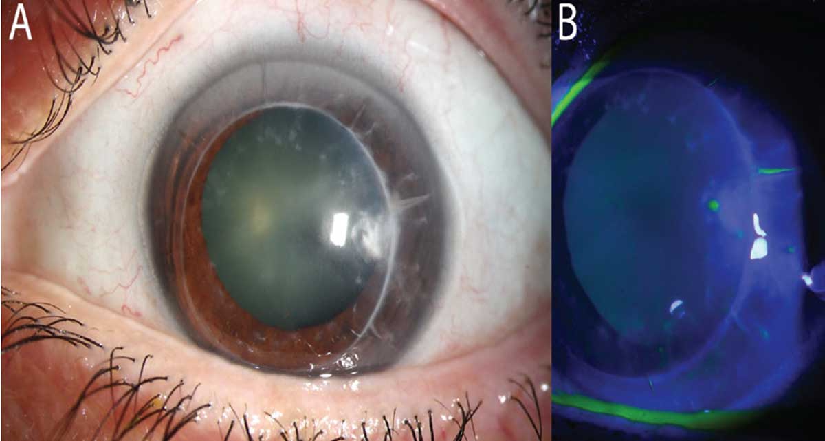 Fig. 1. (a) Minimal conjunctival injection (post phenylephrine/dilation). Notice the PKP graft with host RK scars. At 3 o’clock, there is a deep but irregular infiltrate. (b) Notice the lack of NaFI staining over the lesion, denoting only a pinpoint epithelial defect where the graft’s suture passed.