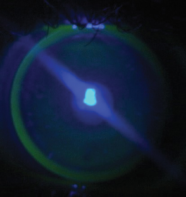Fig. 2. A well-fit bitoric lens on an astigmatic cornea demonstrates an appropriate fit with central alignment, mid-peripheral bearing and adequate edge lift.